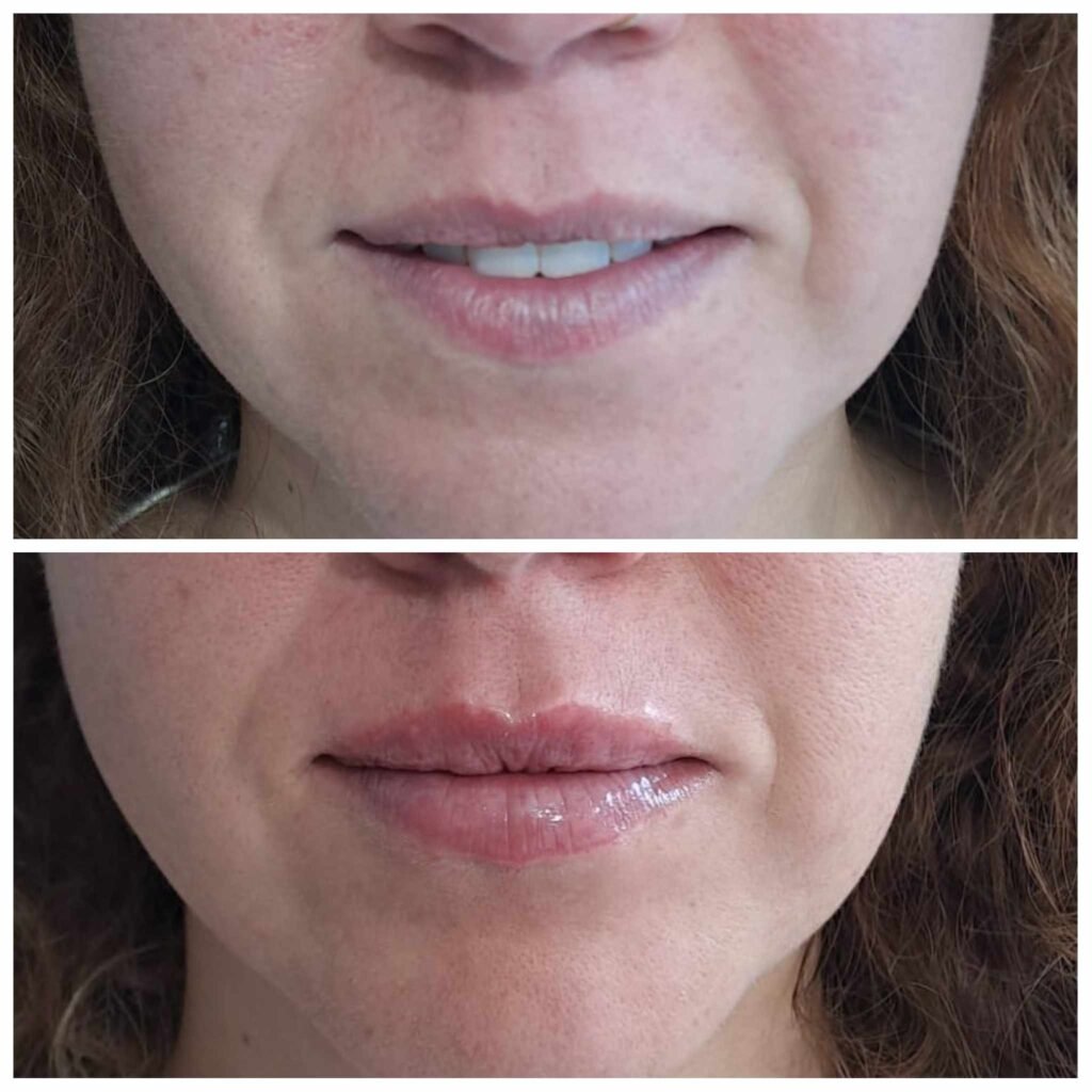 Antes y después con ácido hialurónico en clínica estética Antes y después con ácido hialurónico en clínica estética