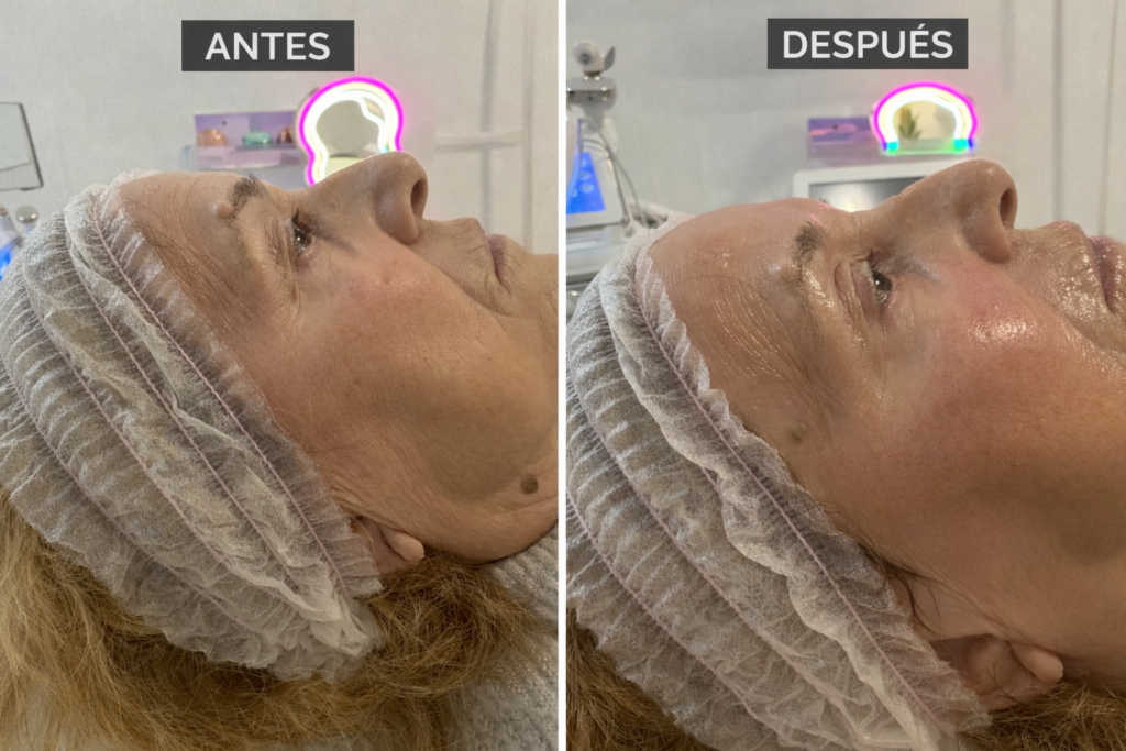 Tratamiento-facial-PDRN-de-salmón-regeneración-y-rejuvenecimiento-de-la-piel Tratamiento facial PDRN de salmon regeneracion y rejuvenecimiento de la piel