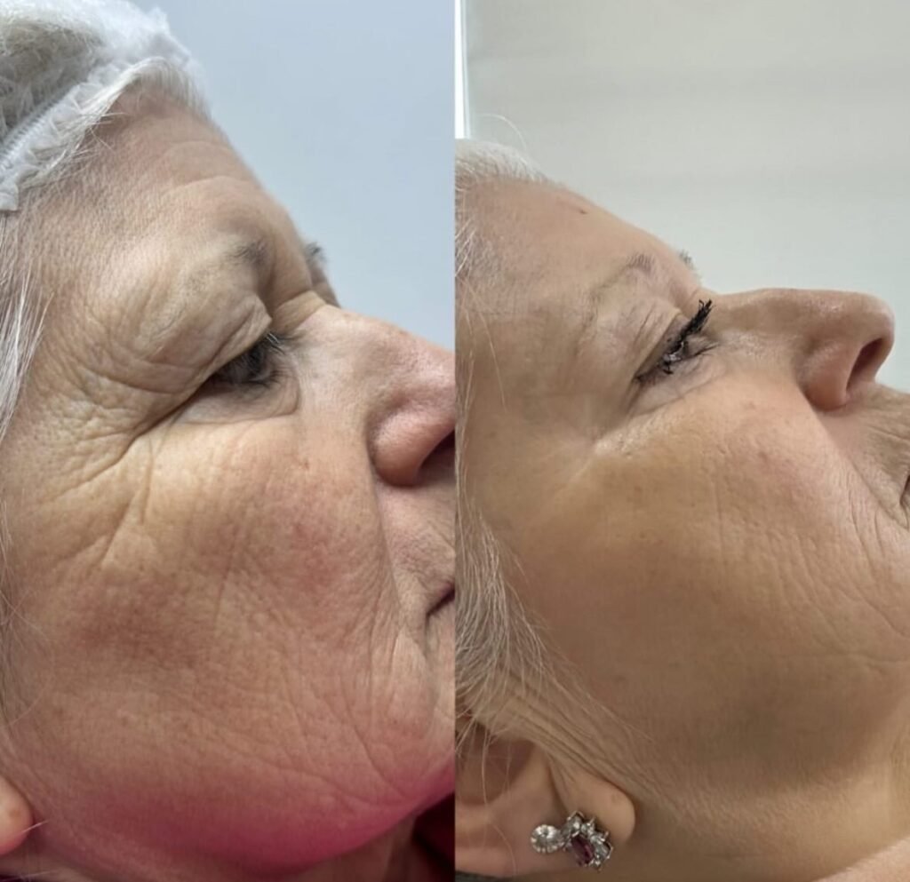 tratamiento-exosomas-antes-despues-piel tratamiento exosomas antes despues piel