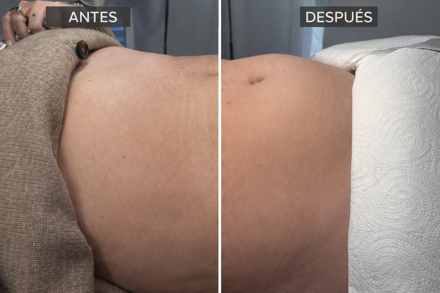 HIFU 7D Corporal tensado profundo y redefinicion del contorno