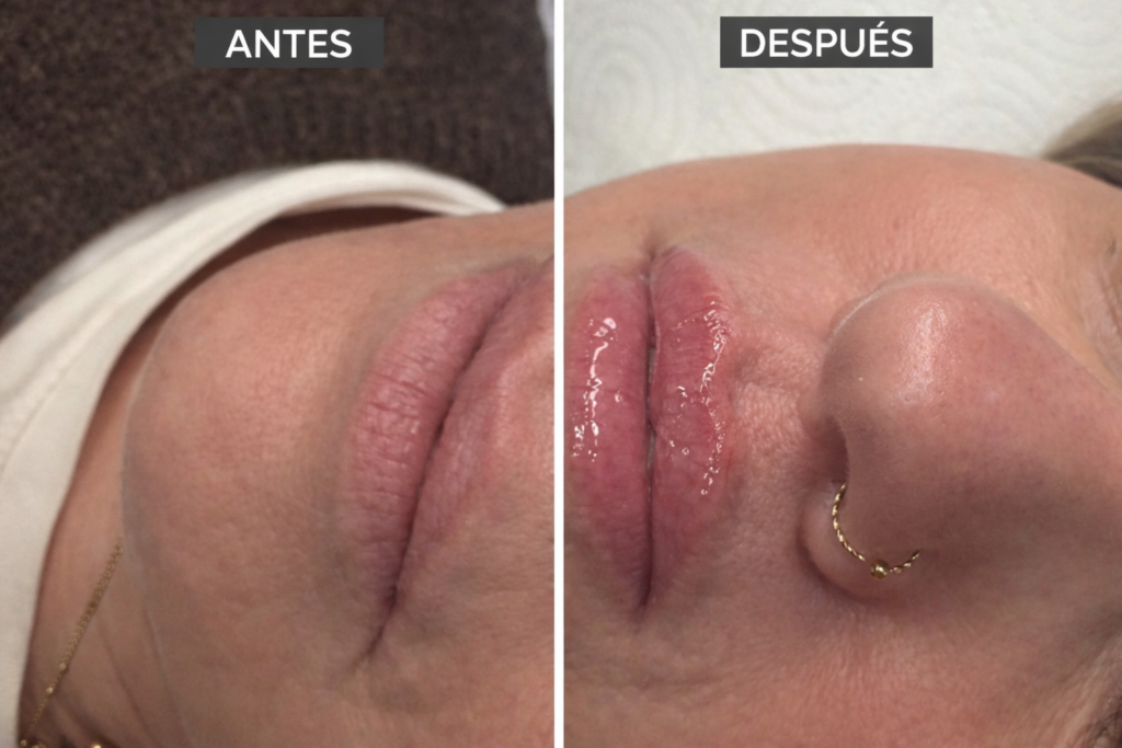 tratamiento-hyaluron-pen-labios-zaragoza tratamiento hyaluron pen labios zaragoza
