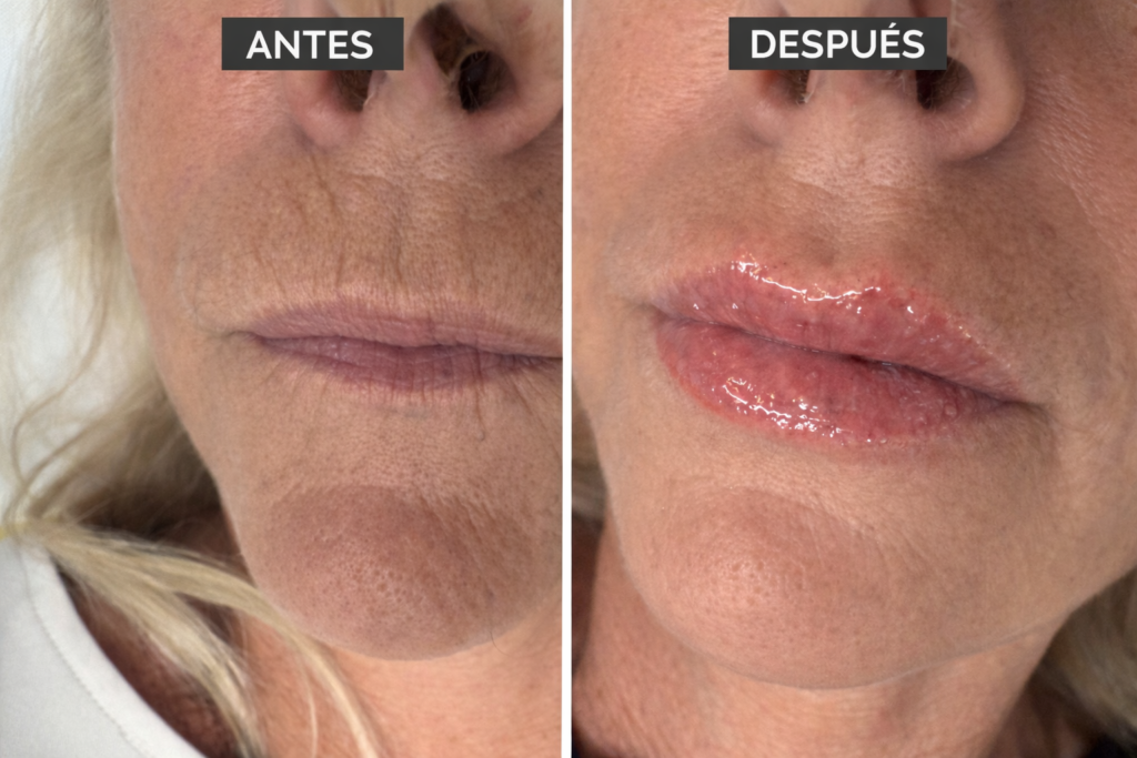 volumen-labios-hyaluron-pen-mayglow volumen labios hyaluron pen mayglow