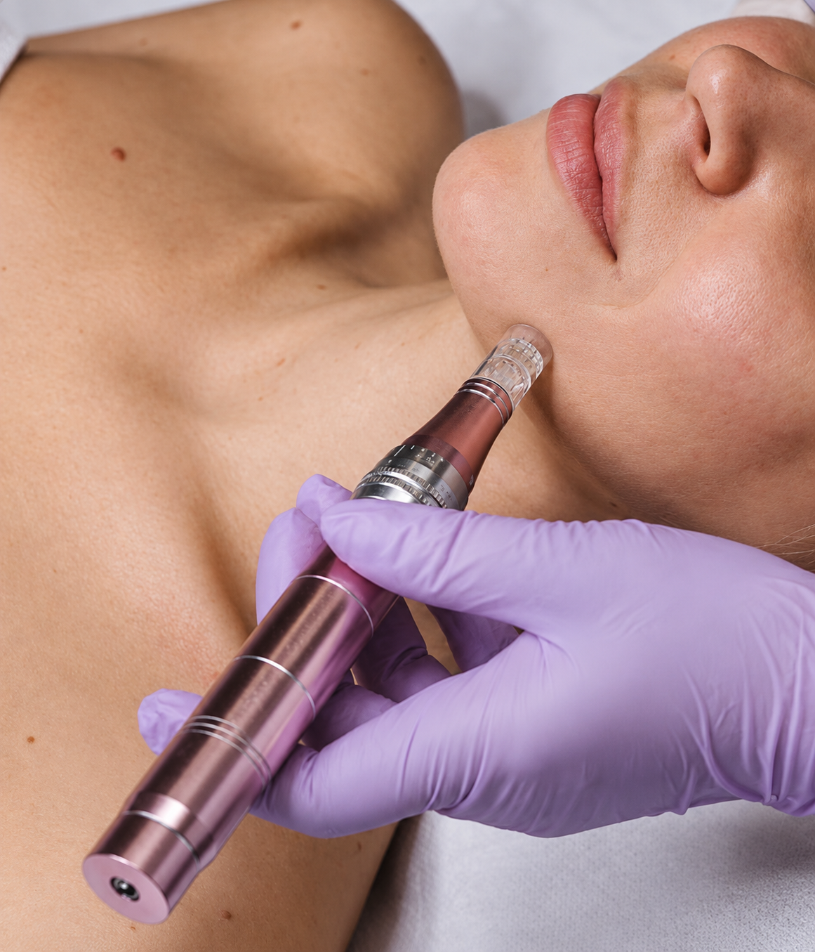 Microdermoabrasion Dermapen con Vitaminasmayglowes