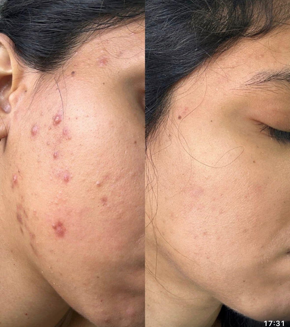 Primer antes y después del Peeling Coreano de Algas en MayGlow