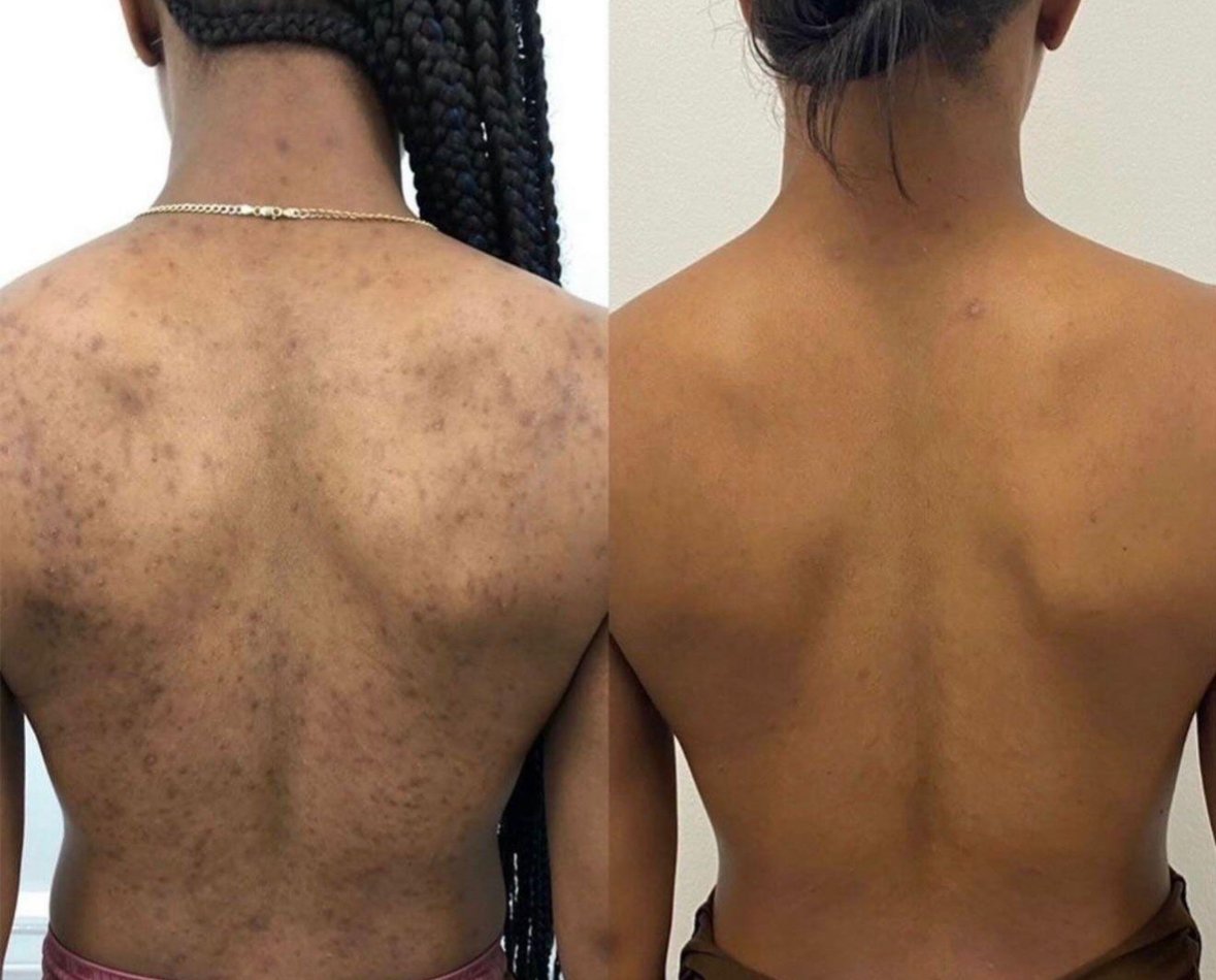 Segundo antes y después del Peeling Coreano de Algas en MayGlow