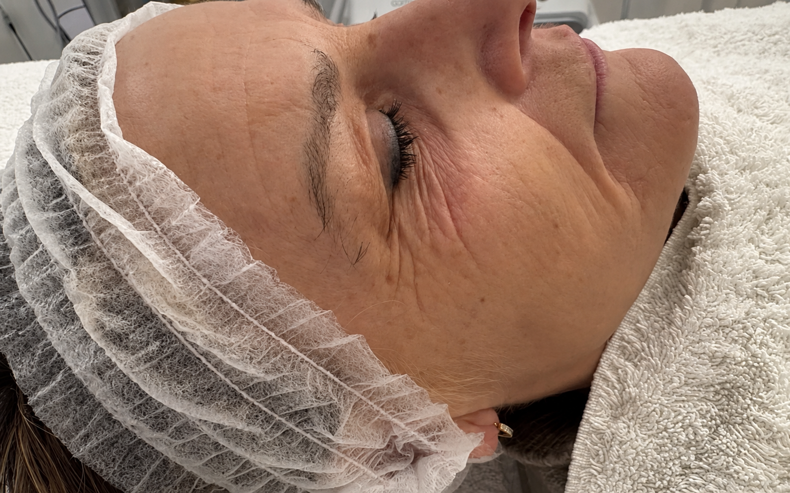 Antes del tratamiento del contorno de ojos