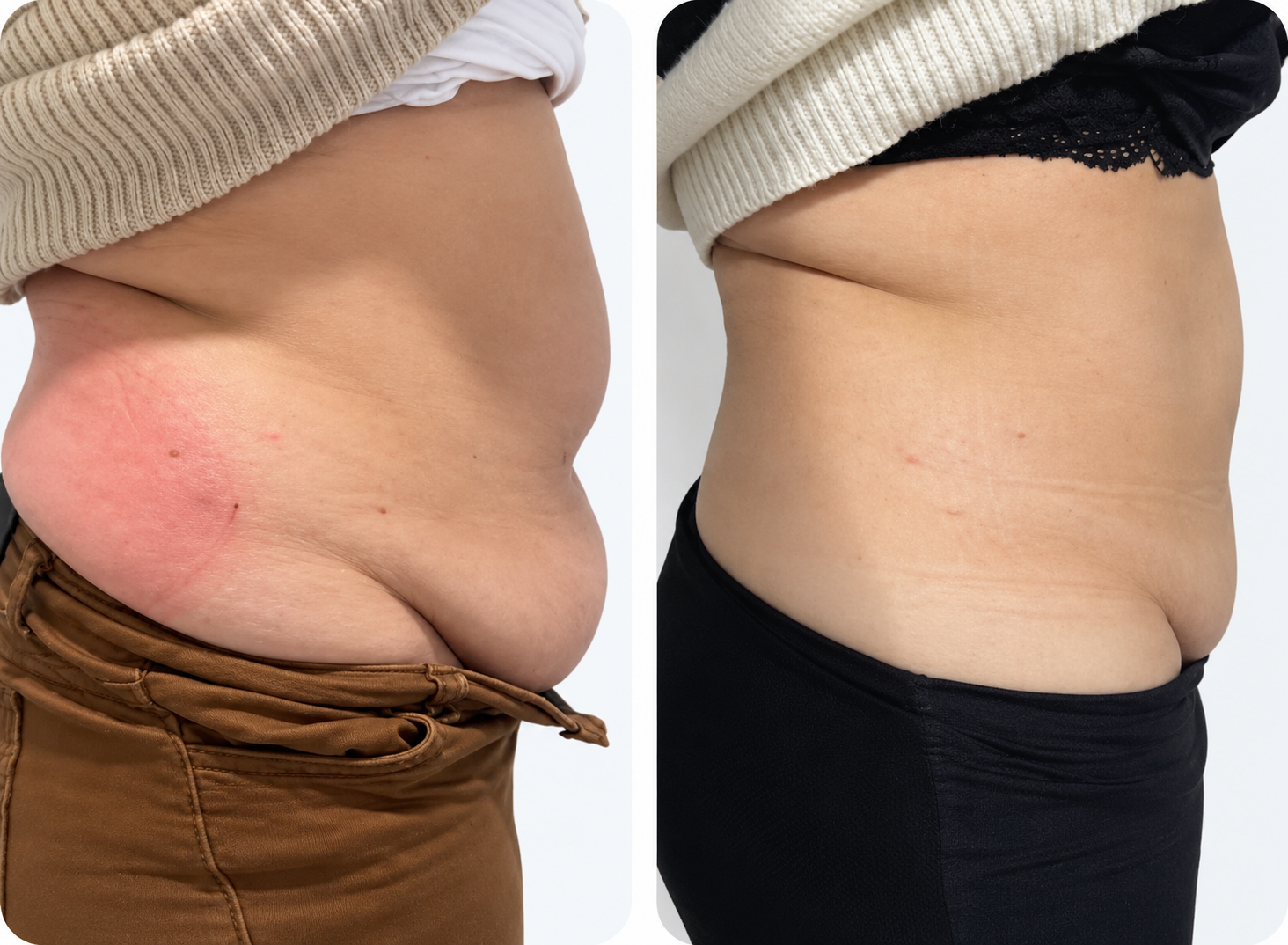 Antes y después de criolipólisis en abdomen