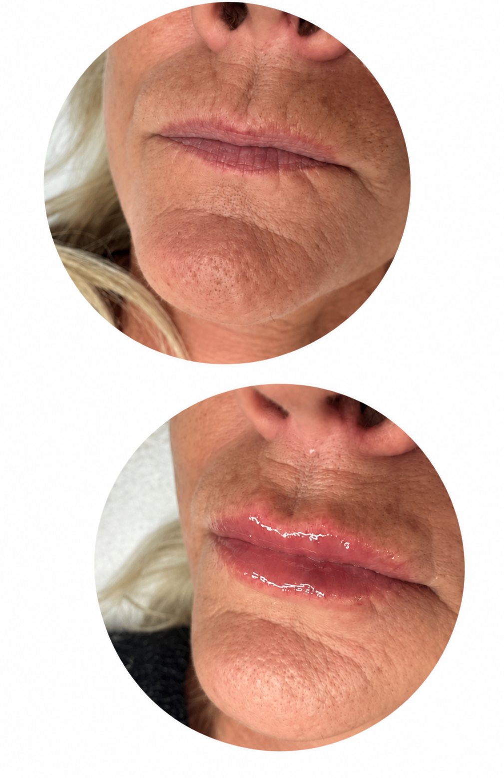 Antes y después de la mejora de asimetrías de los labios