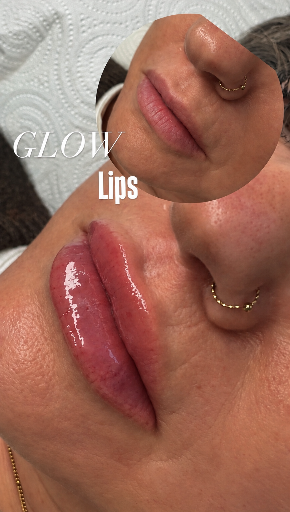 Antes y después del aumento de volumen de labios