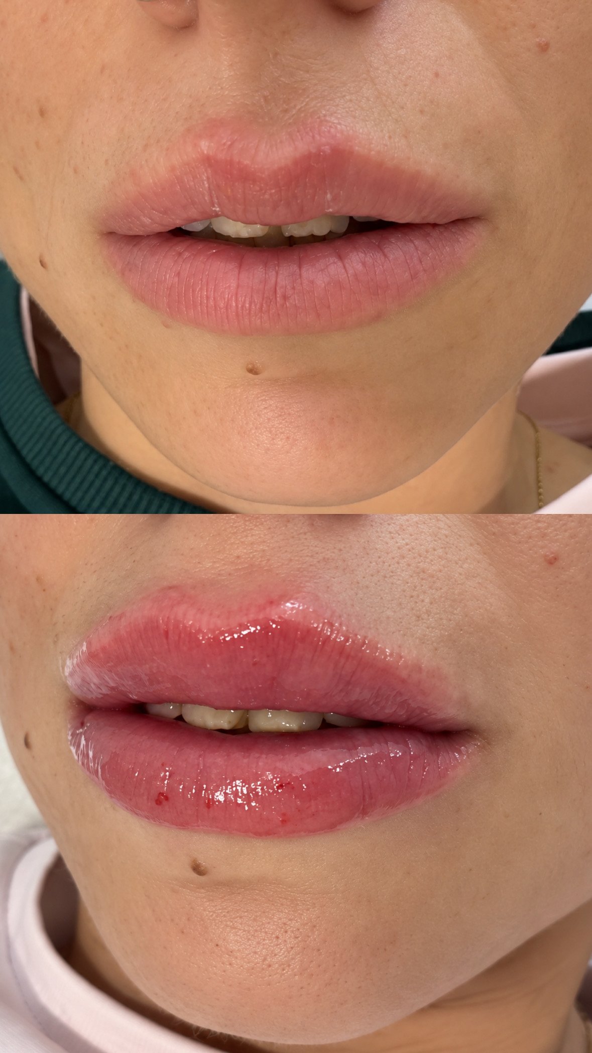 Antes y después de la definición del arco de Cupido