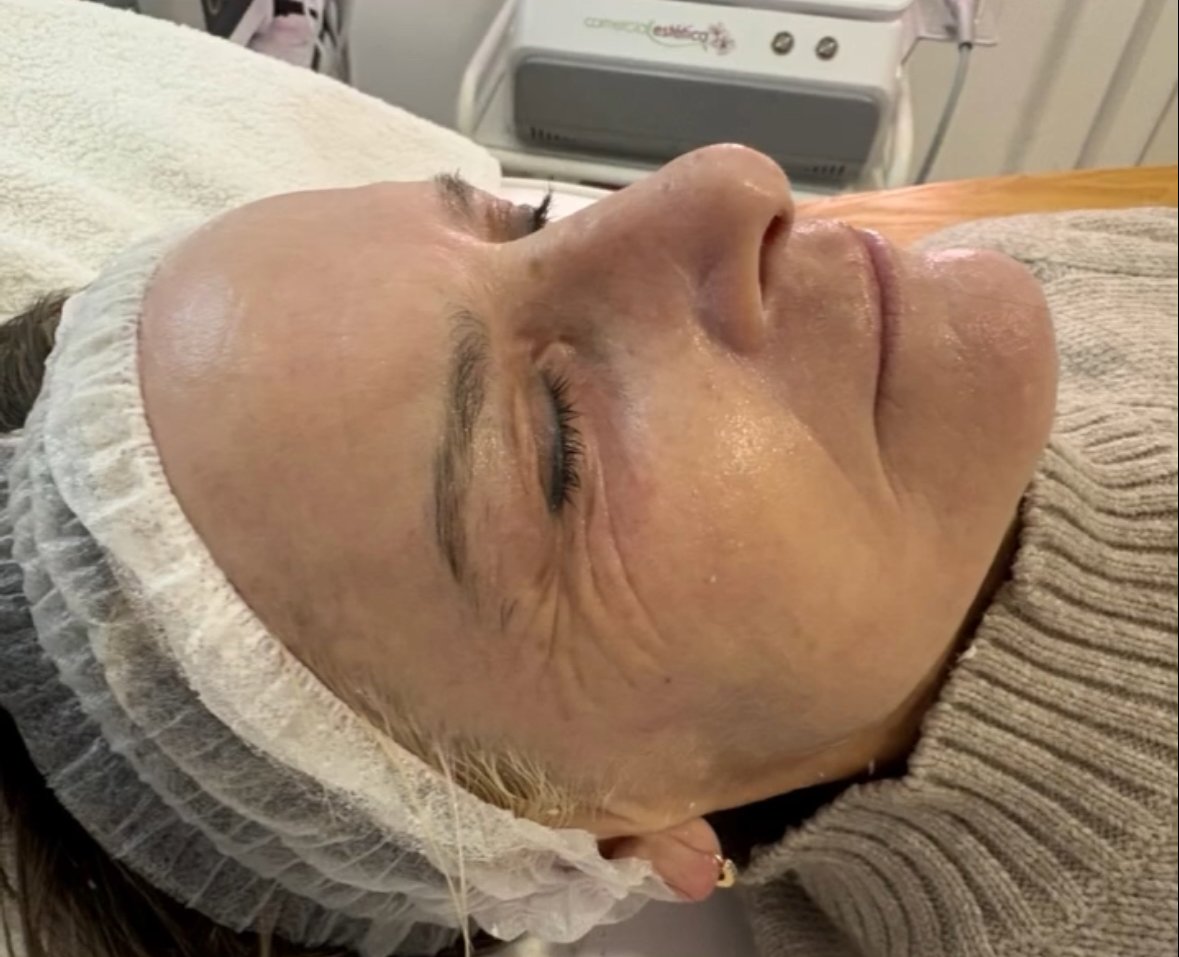 Después del tratamiento del contorno de ojos
