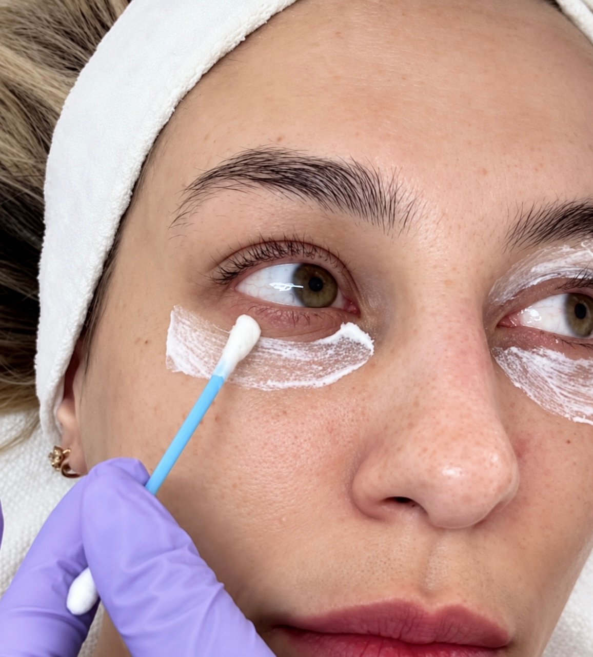 Peeling de ojeras en Zaragoza
