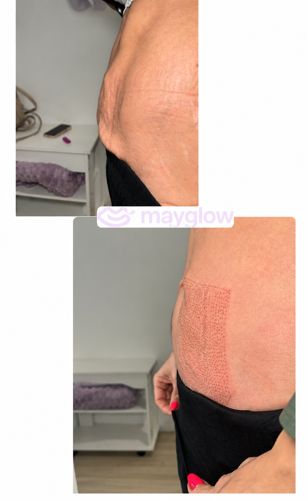 Antes y después Plasma Pen abdomen
