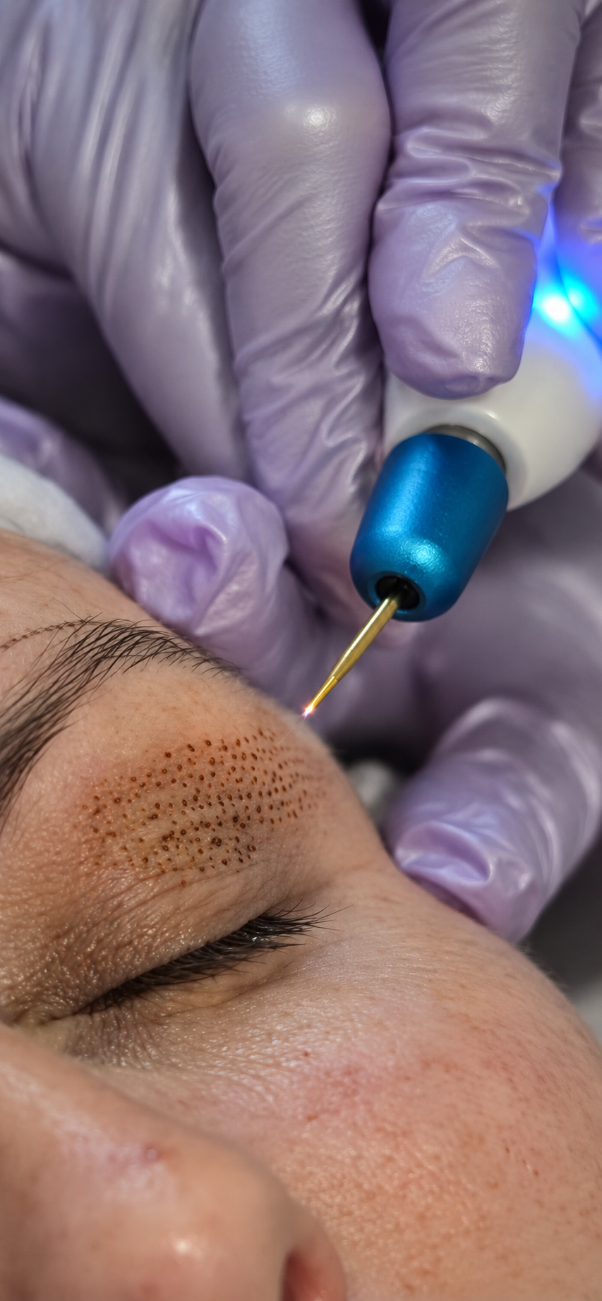 Tratamiento Plasma Pen en MayGlow